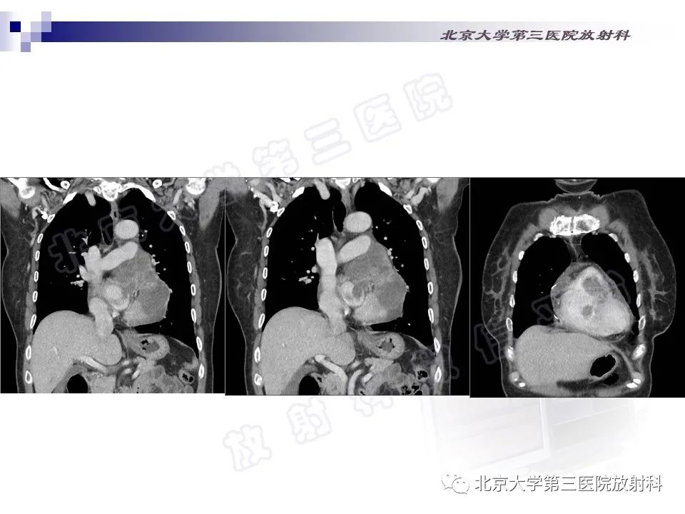 影像PPT - 【PPT】心脏原发性未分化多形性肉瘤-6