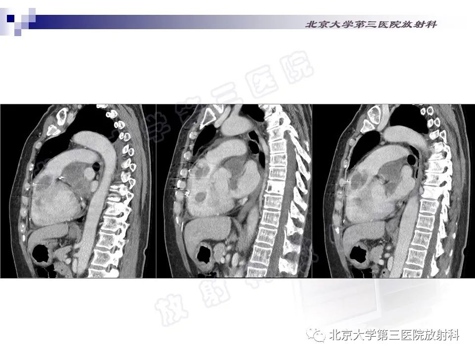 影像PPT - 【PPT】心脏原发性未分化多形性肉瘤-5
