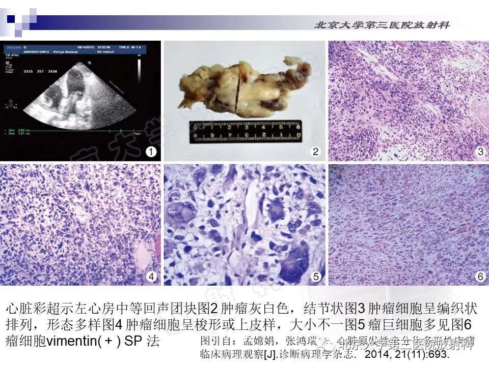影像PPT - 【PPT】心脏原发性未分化多形性肉瘤-18