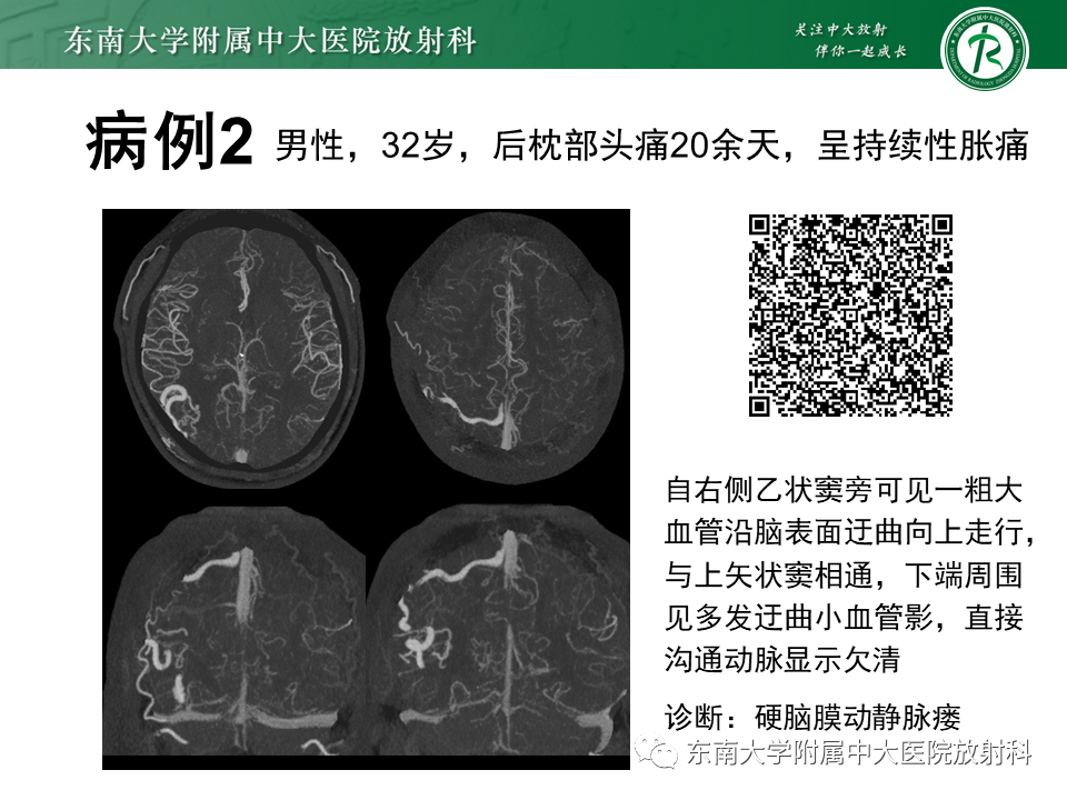 影像PPT - 【PPT】高流量脑血管畸形-5 影像PPT - 【PPT】高流量脑血管畸形-5