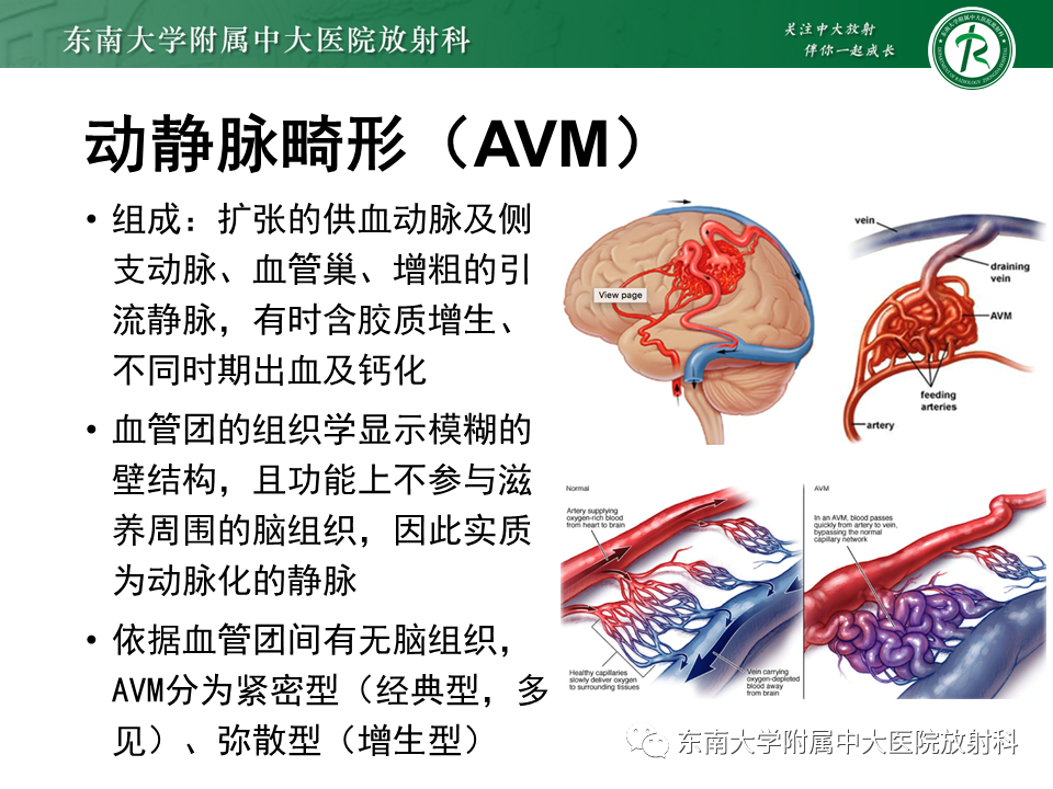 影像PPT - 【PPT】高流量脑血管畸形-10 影像PPT - 【PPT】高流量脑血管畸形-10