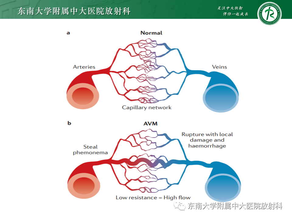 影像PPT - 【PPT】高流量脑血管畸形-9 影像PPT - 【PPT】高流量脑血管畸形-9