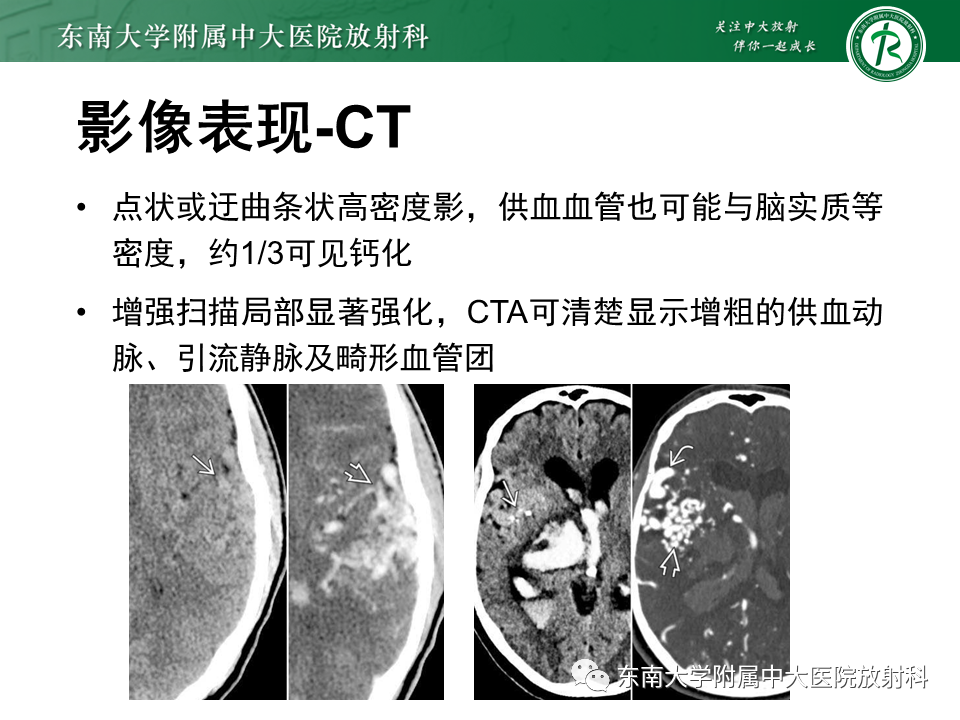 影像PPT - 【PPT】高流量脑血管畸形-12 影像PPT - 【PPT】高流量脑血管畸形-12