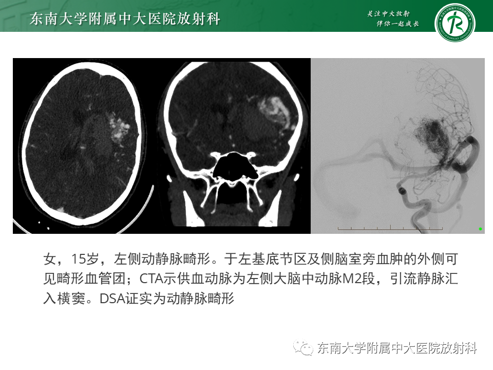 影像PPT - 【PPT】高流量脑血管畸形-13 影像PPT - 【PPT】高流量脑血管畸形-13