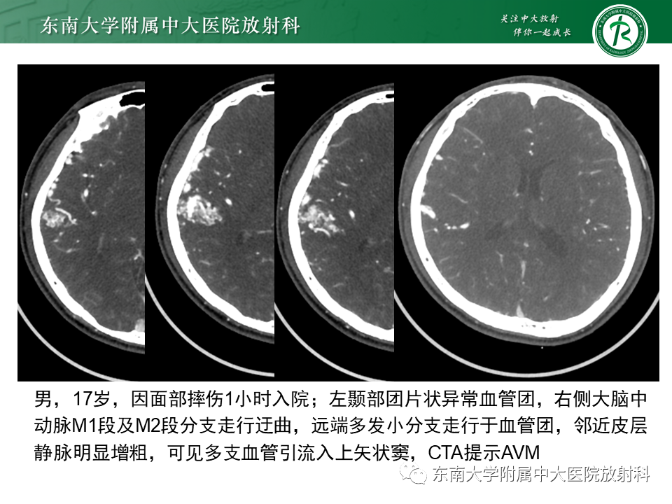 影像PPT - 【PPT】高流量脑血管畸形-14 影像PPT - 【PPT】高流量脑血管畸形-14