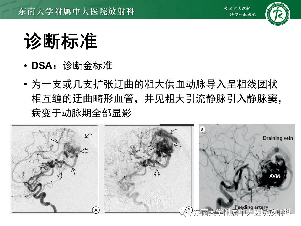 影像PPT - 【PPT】高流量脑血管畸形-18 影像PPT - 【PPT】高流量脑血管畸形-18