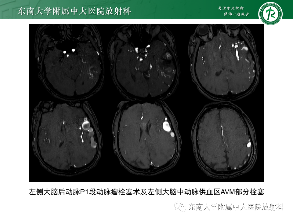 影像PPT - 【PPT】高流量脑血管畸形-17 影像PPT - 【PPT】高流量脑血管畸形-17