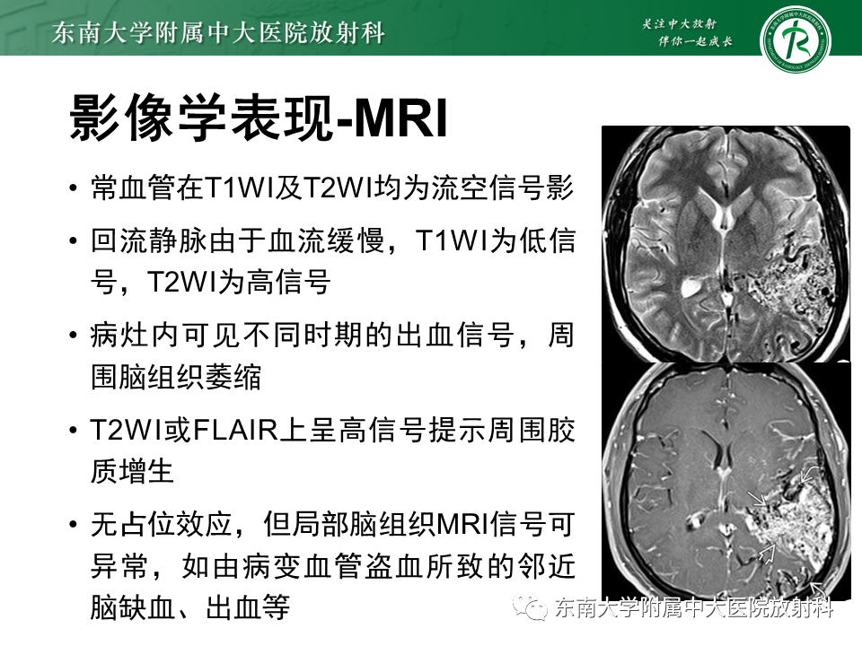 影像PPT - 【PPT】高流量脑血管畸形-15 影像PPT - 【PPT】高流量脑血管畸形-15