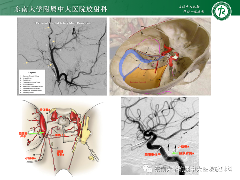 影像PPT - 【PPT】高流量脑血管畸形-24 影像PPT - 【PPT】高流量脑血管畸形-24