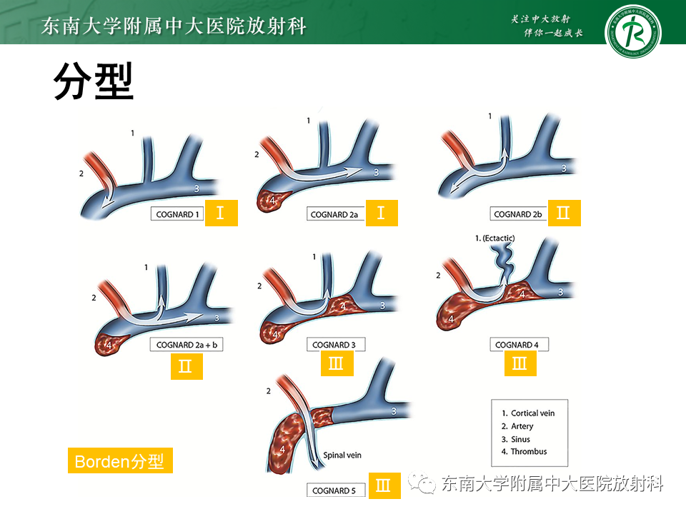 影像PPT - 【PPT】高流量脑血管畸形-29 影像PPT - 【PPT】高流量脑血管畸形-29