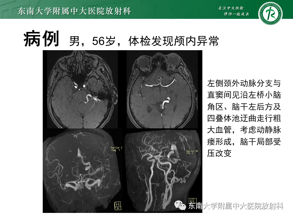 影像PPT - 【PPT】高流量脑血管畸形-32 影像PPT - 【PPT】高流量脑血管畸形-32