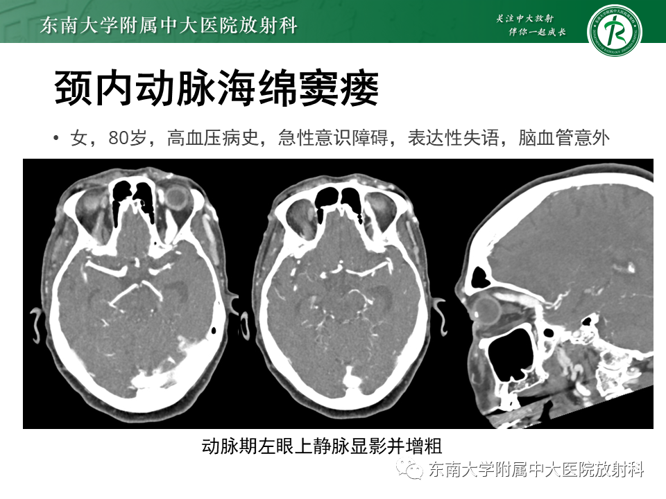 影像PPT - 【PPT】高流量脑血管畸形-36 影像PPT - 【PPT】高流量脑血管畸形-36