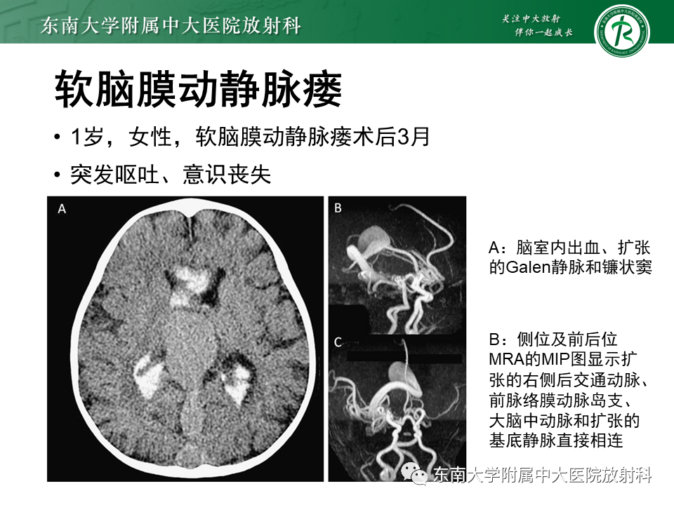 影像PPT - 【PPT】高流量脑血管畸形-38 影像PPT - 【PPT】高流量脑血管畸形-38
