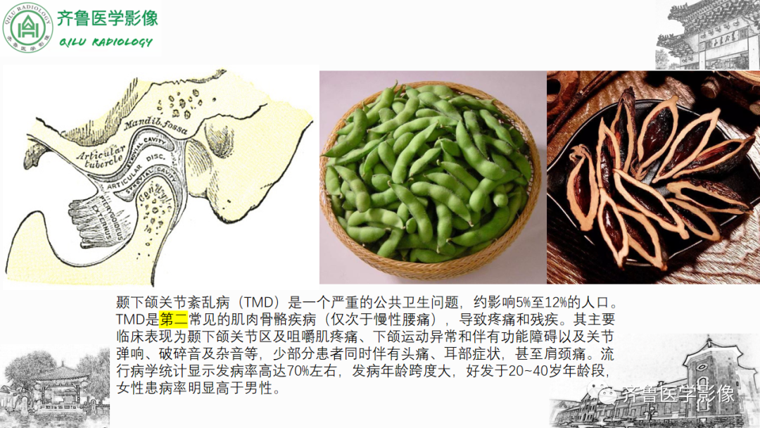 影像PPT - 【PPT】颞下颌关节紊乱-5