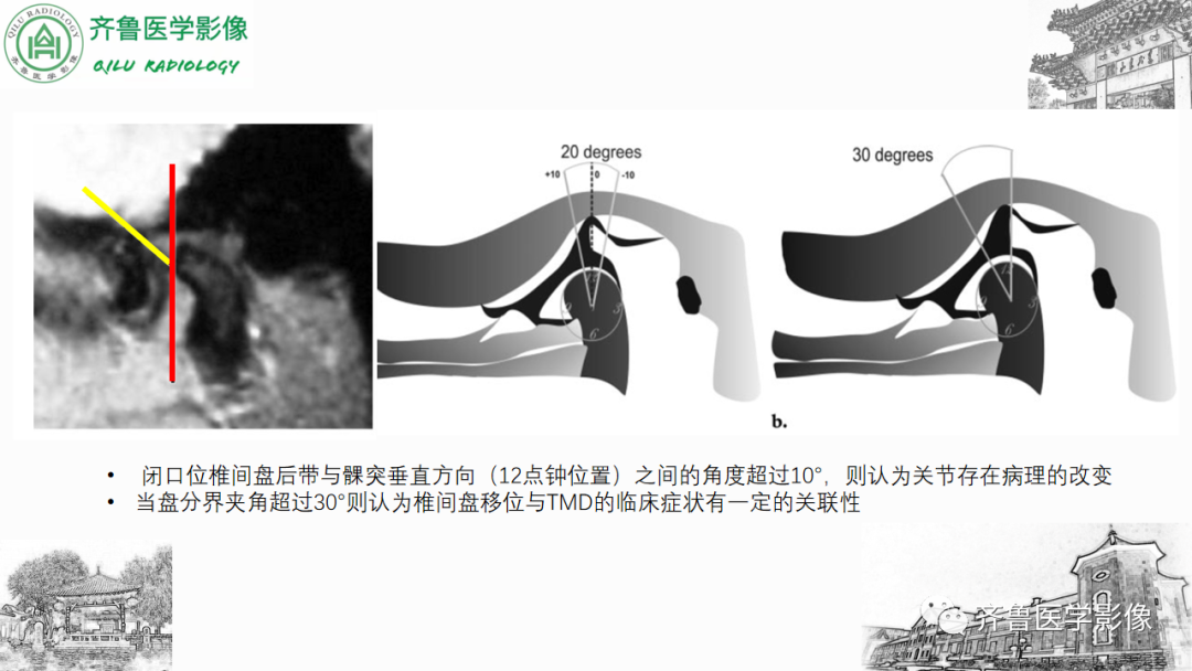 影像PPT - 【PPT】颞下颌关节紊乱-24