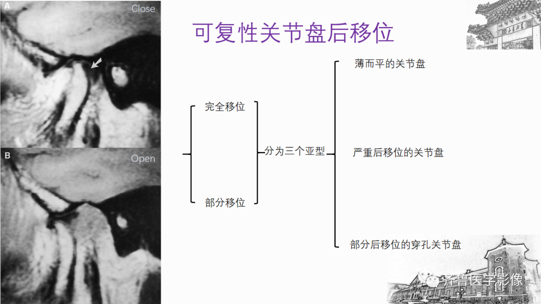 影像PPT - 【PPT】颞下颌关节紊乱-28