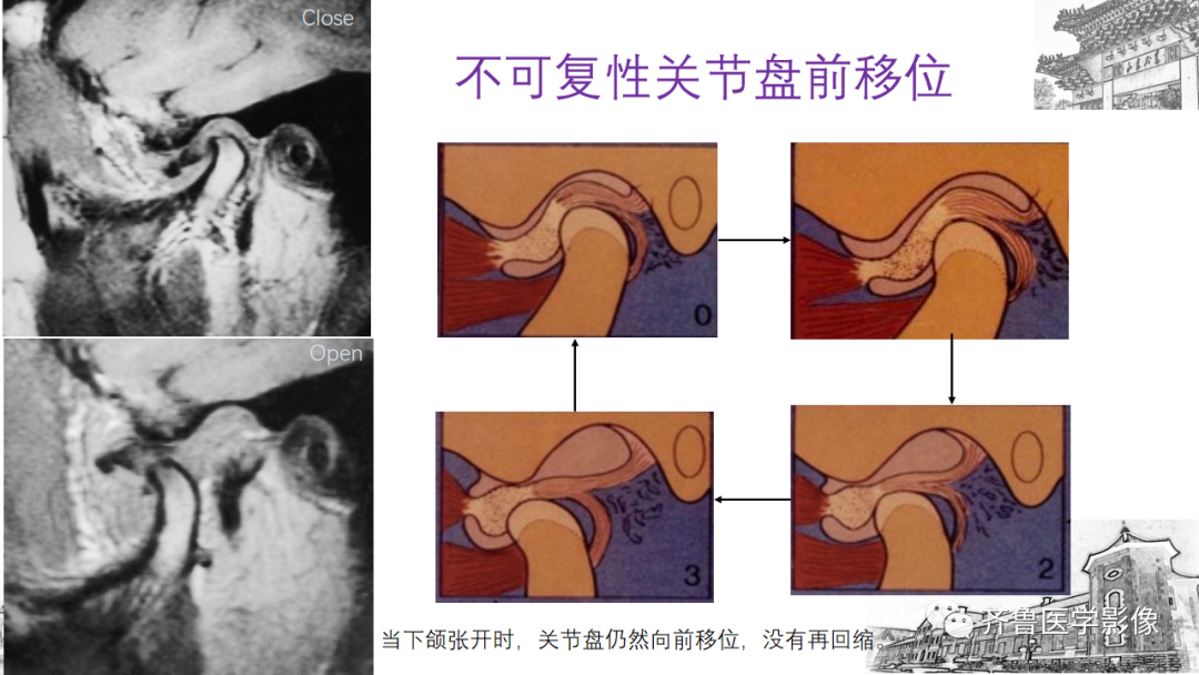 影像PPT - 【PPT】颞下颌关节紊乱-26