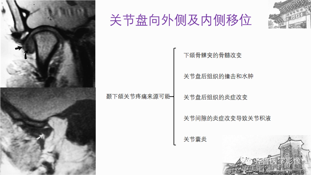 影像PPT - 【PPT】颞下颌关节紊乱-29