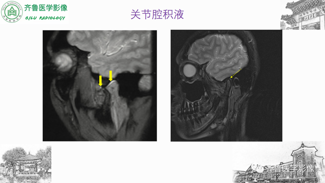 影像PPT - 【PPT】颞下颌关节紊乱-34
