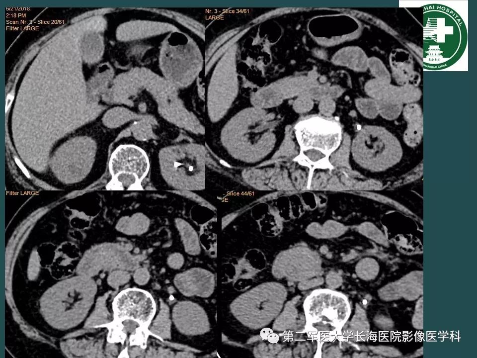 影像PPT - 【PPT】常见的腹膜后占位诊断及鉴别诊断-3