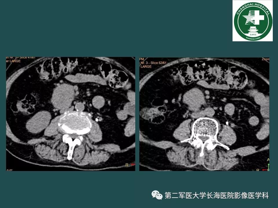 影像PPT - 【PPT】常见的腹膜后占位诊断及鉴别诊断-4