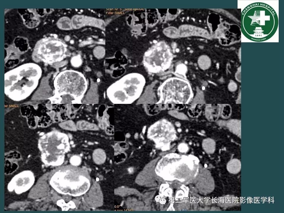 影像PPT - 【PPT】常见的腹膜后占位诊断及鉴别诊断-8