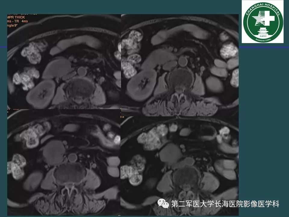 影像PPT - 【PPT】常见的腹膜后占位诊断及鉴别诊断-10