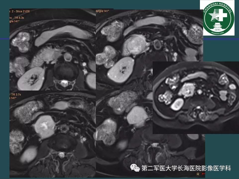 影像PPT - 【PPT】常见的腹膜后占位诊断及鉴别诊断-11