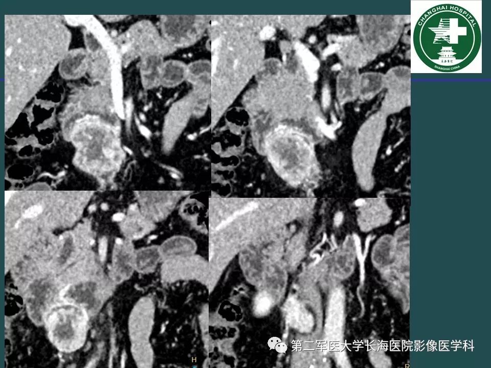 影像PPT - 【PPT】常见的腹膜后占位诊断及鉴别诊断-9