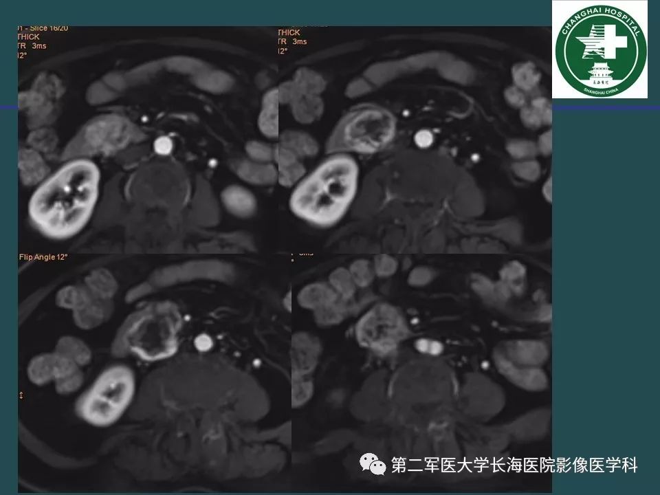 影像PPT - 【PPT】常见的腹膜后占位诊断及鉴别诊断-12