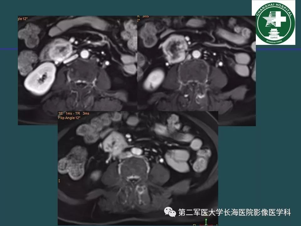 影像PPT - 【PPT】常见的腹膜后占位诊断及鉴别诊断-13