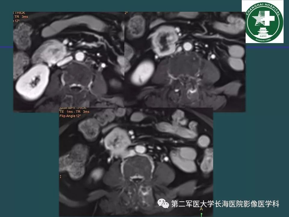 影像PPT - 【PPT】常见的腹膜后占位诊断及鉴别诊断-14