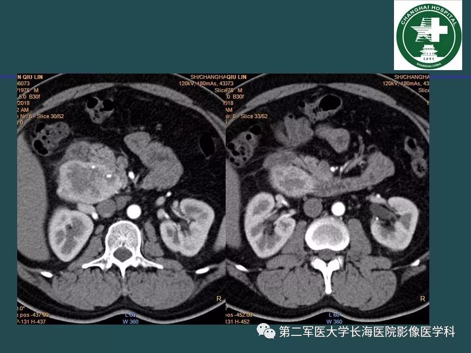 影像PPT - 【PPT】常见的腹膜后占位诊断及鉴别诊断-21