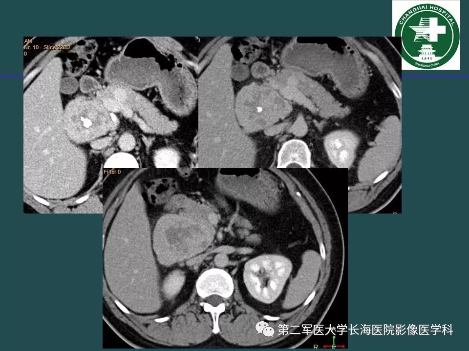 影像PPT - 【PPT】常见的腹膜后占位诊断及鉴别诊断-24