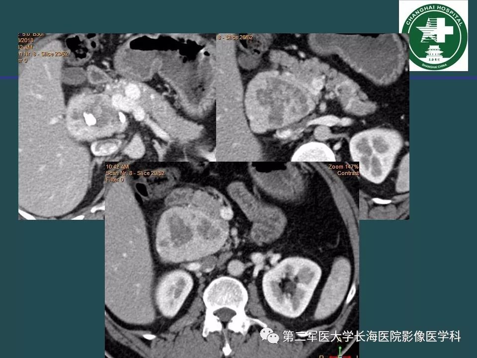 影像PPT - 【PPT】常见的腹膜后占位诊断及鉴别诊断-22