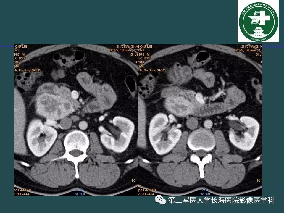 影像PPT - 【PPT】常见的腹膜后占位诊断及鉴别诊断-23