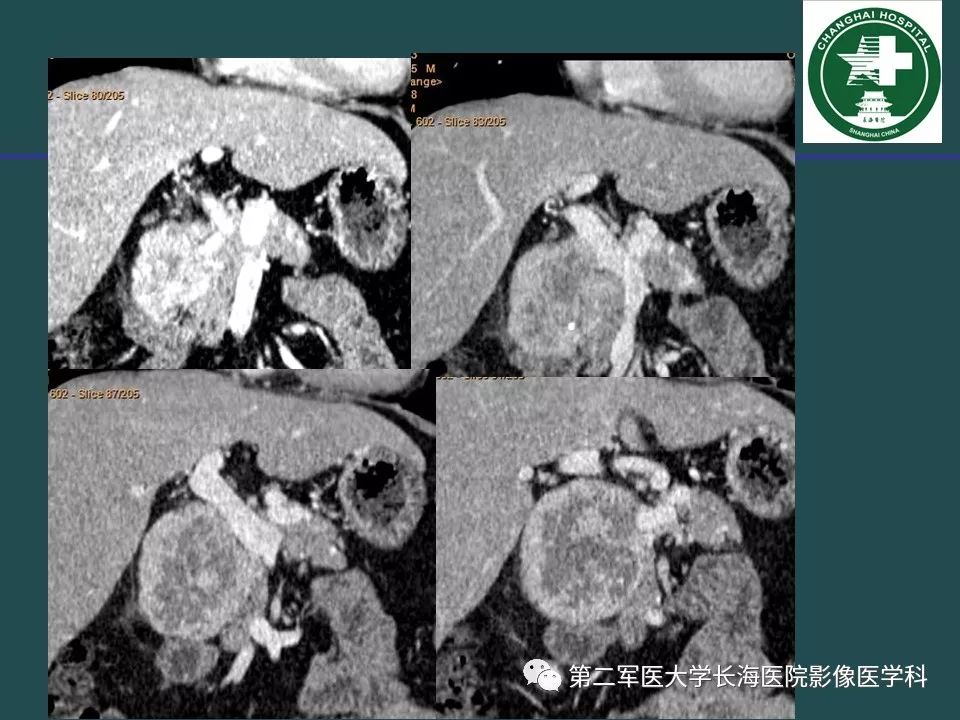 影像PPT - 【PPT】常见的腹膜后占位诊断及鉴别诊断-26