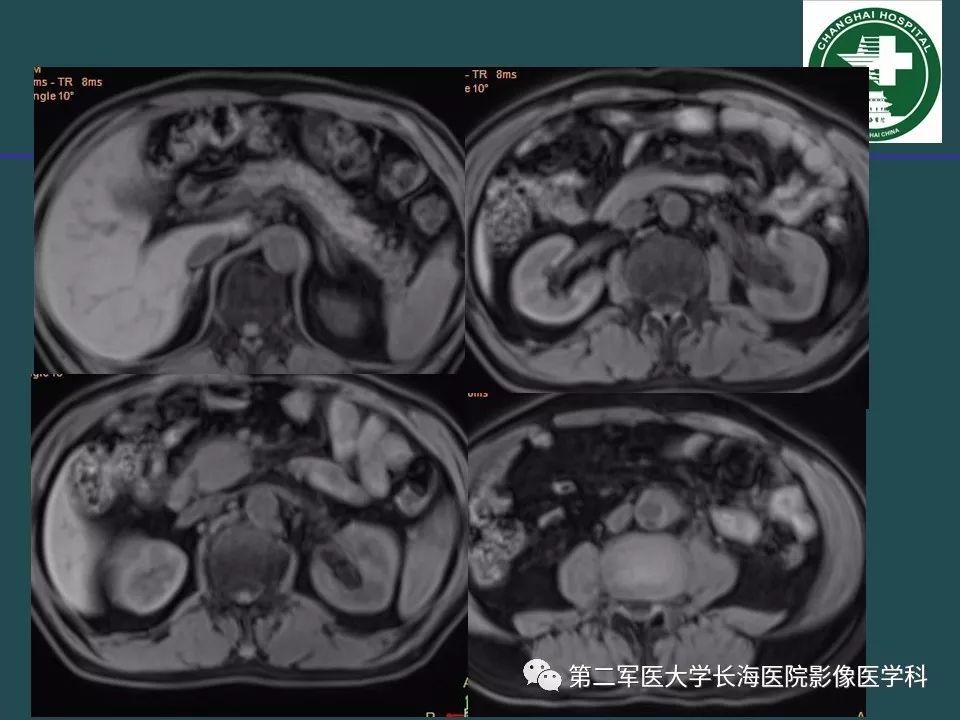 影像PPT - 【PPT】常见的腹膜后占位诊断及鉴别诊断-30