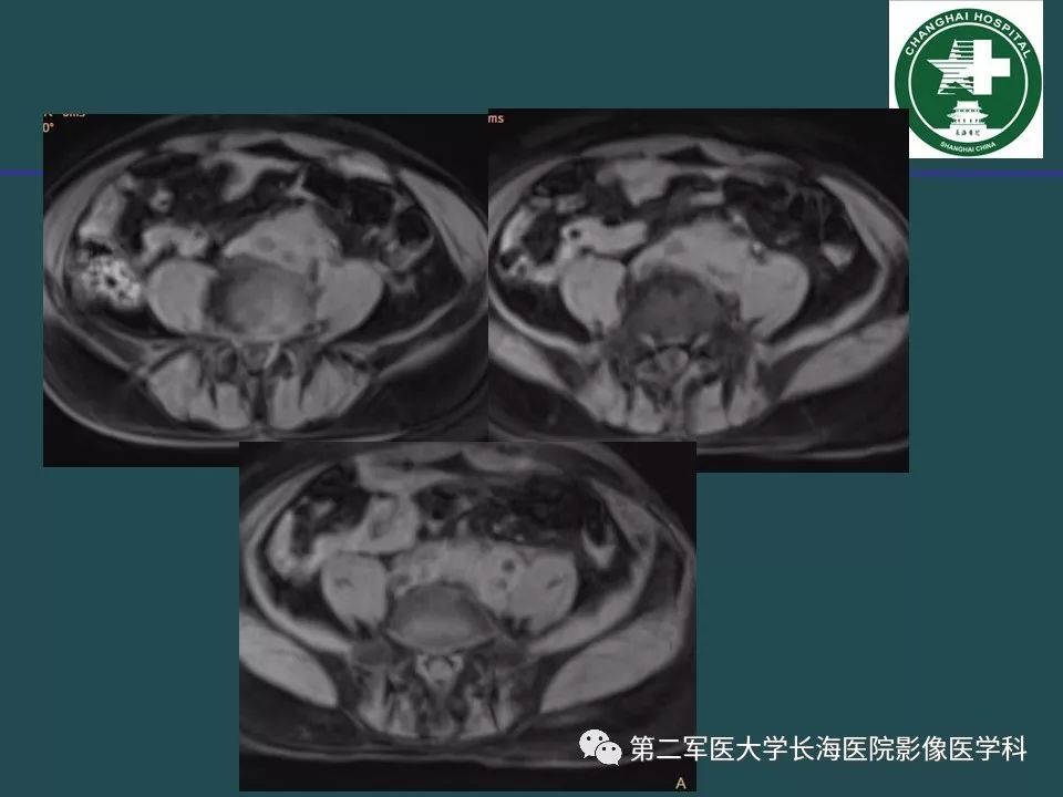 影像PPT - 【PPT】常见的腹膜后占位诊断及鉴别诊断-31