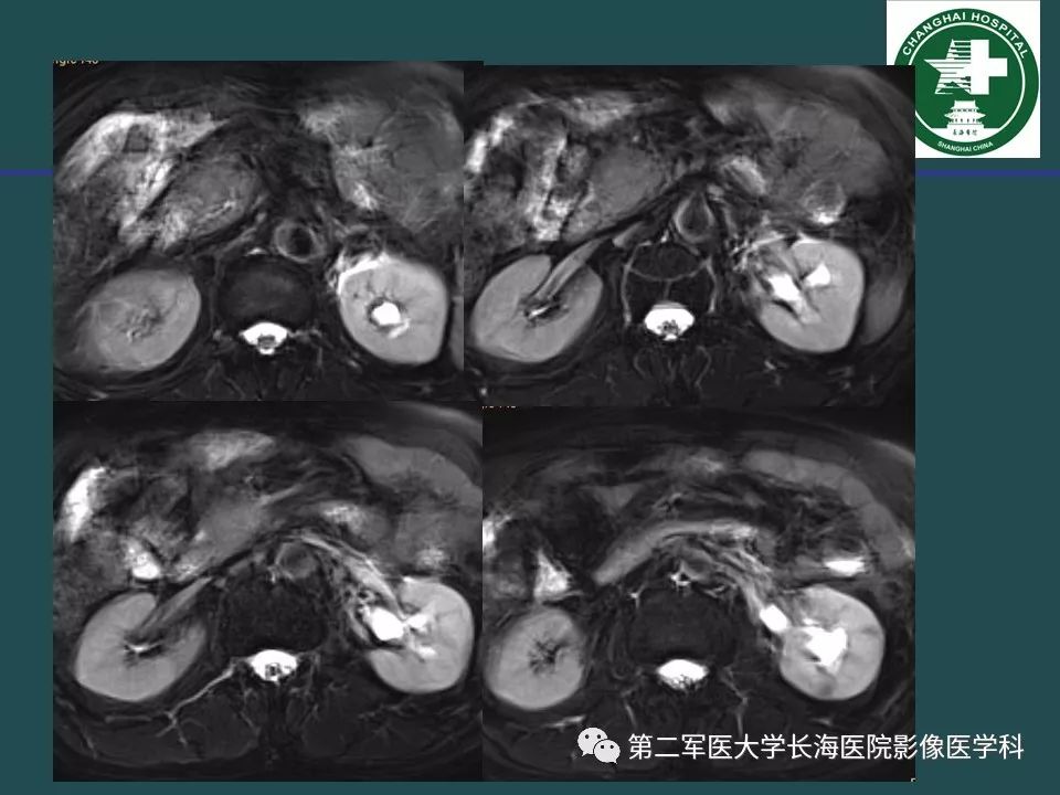影像PPT - 【PPT】常见的腹膜后占位诊断及鉴别诊断-32