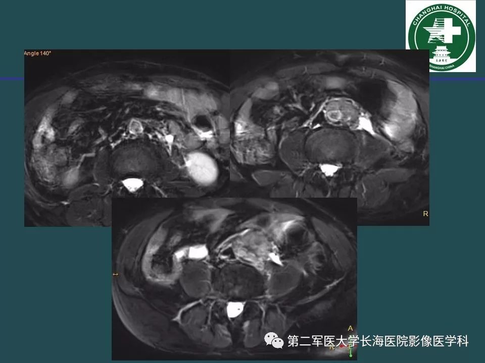 影像PPT - 【PPT】常见的腹膜后占位诊断及鉴别诊断-33