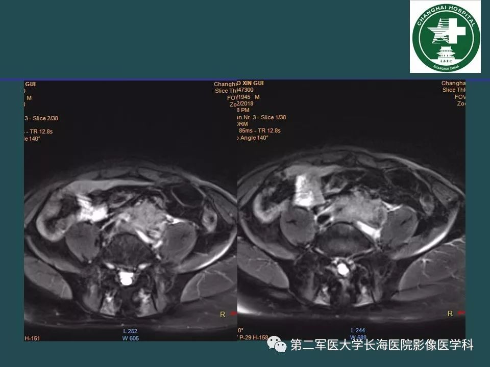影像PPT - 【PPT】常见的腹膜后占位诊断及鉴别诊断-34