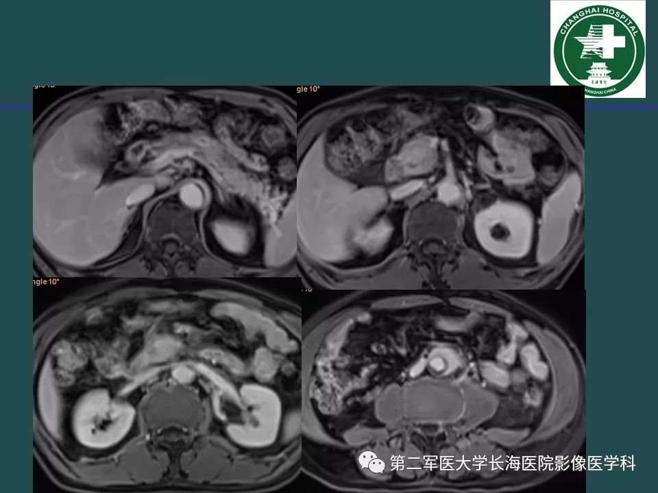 影像PPT - 【PPT】常见的腹膜后占位诊断及鉴别诊断-36