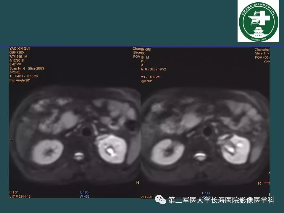影像PPT - 【PPT】常见的腹膜后占位诊断及鉴别诊断-35