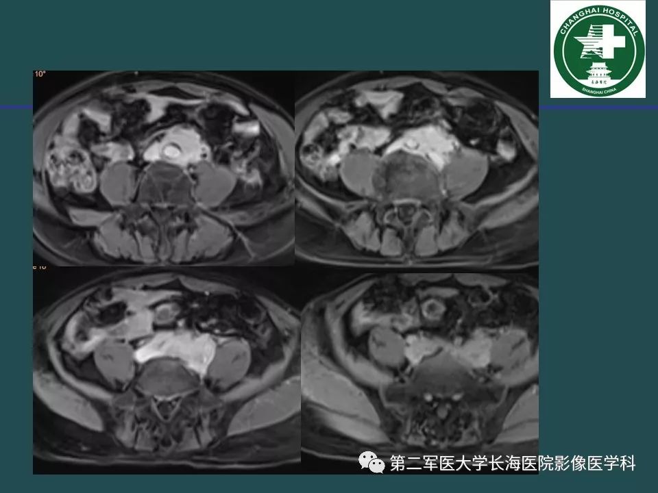 影像PPT - 【PPT】常见的腹膜后占位诊断及鉴别诊断-37