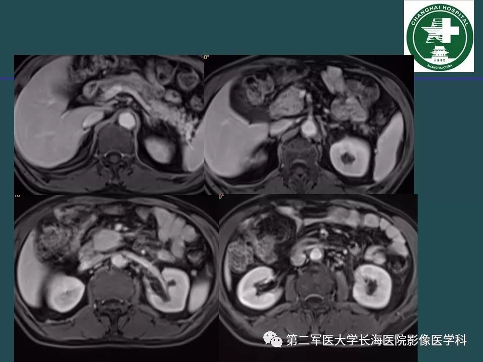 影像PPT - 【PPT】常见的腹膜后占位诊断及鉴别诊断-38