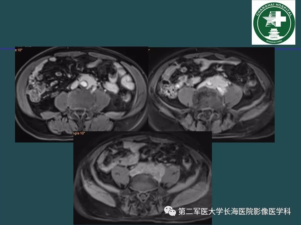 影像PPT - 【PPT】常见的腹膜后占位诊断及鉴别诊断-39