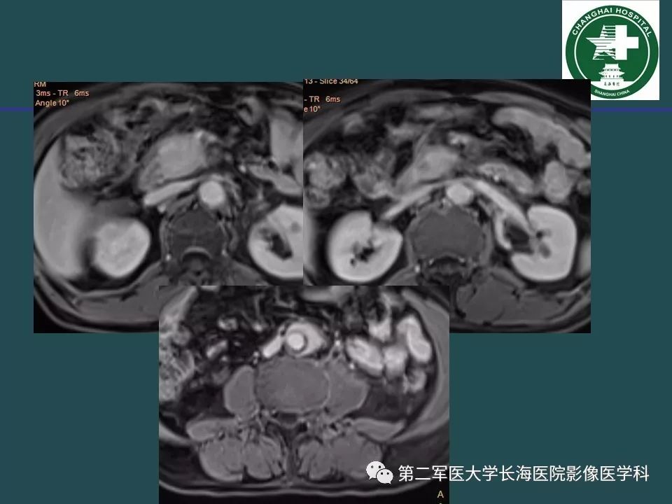 影像PPT - 【PPT】常见的腹膜后占位诊断及鉴别诊断-40