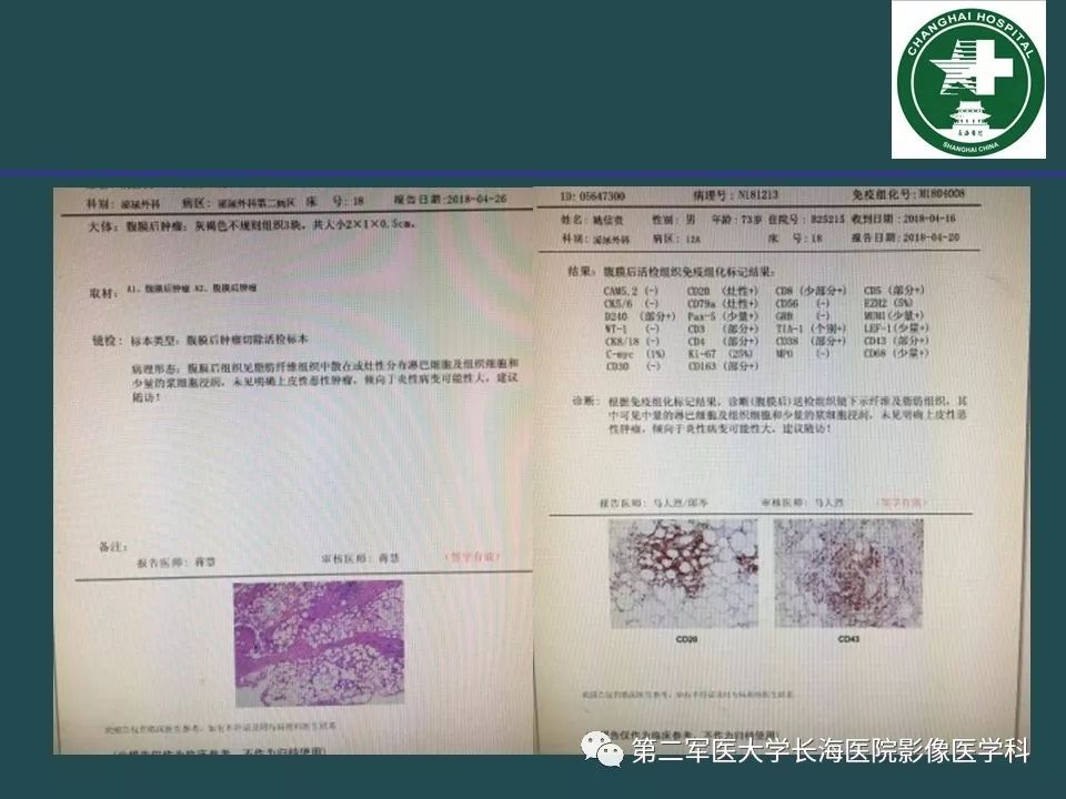 影像PPT - 【PPT】常见的腹膜后占位诊断及鉴别诊断-43