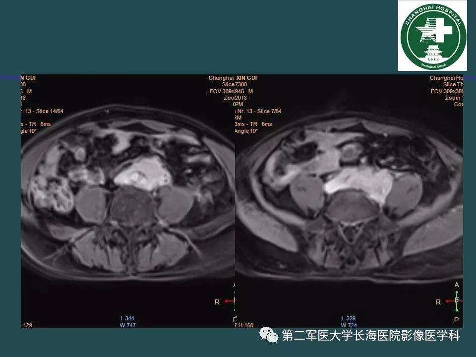 影像PPT - 【PPT】常见的腹膜后占位诊断及鉴别诊断-41